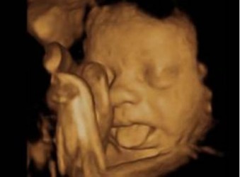 4D ultrazvuk trojrozměrné zobrazení